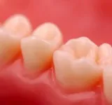 Third Molar Socket Grafting