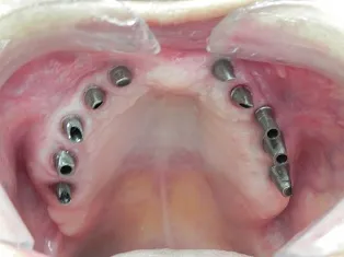 Case 1 Full Mouth Implant Rehabilitation Before Photo 