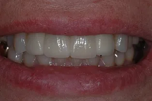 Case 1 Single Implants After Photo