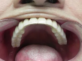 Case 1 Full Mouth Implant Rehabilitation After Photo 