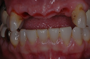 Case 1 Single Implants Before Photo