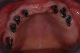 Case 3 Full Mouth Implant Rehabilitation Before Photo 