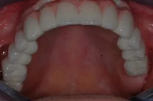 Case 3 Full Mouth Implant Rehabilitation After Photo 