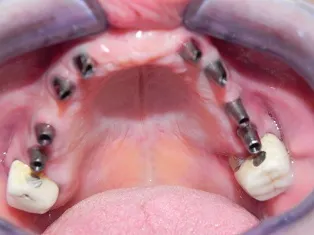 Case 2 Full Mouth Implant Rehabilitation Before Photo 