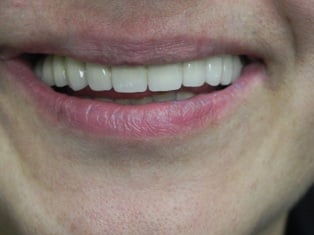 Case 2 Full Mouth Implant Rehabilitation After Photo 